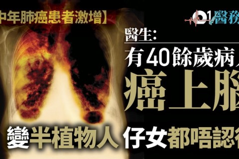 【肺癌】中年新症15年增一半　醫生指密室易積氡氣長期吸入可致癌 (香港01  5/5/2018)